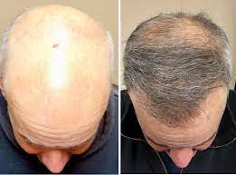 What is a Direct Hair Transplant and Dermatologist Surgeon?